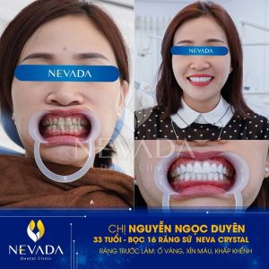 Hình ảnh bọc răng sứ của KH Nguyễn Ngọc Duyên – Ca 50