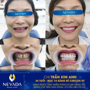 Hình ảnh bọc 18 răng sứ Cercon HT của KH Trần Kim Anh – Ca 51
