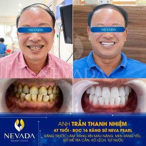 Hình ảnh bọc răng sứ của KH Trần Thanh Nhiệm – Ca 52