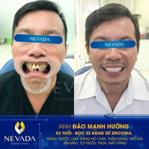 Hình ảnh bọc răng sứ Zirconia của KH Đào Mạnh Hưởng – Ca 53