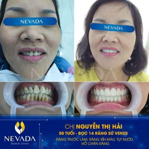 Hình ảnh bọc răng sứ Venus của KH Nguyễn Thị Hải – Ca 54