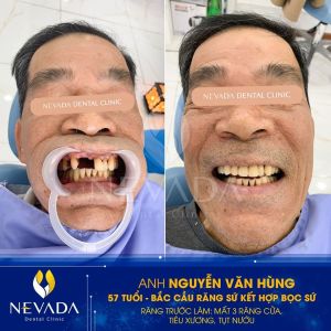 Hình ảnh phục hình răng của KH Nguyễn Văn Hùng – Ca 55