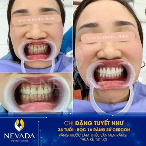 Hình ảnh bọc răng sứ của KH Đặng Tuyết Như – Ca 59