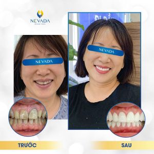 Hình ảnh bọc răng sứ của khách hàng Trần Mai Anh - Ca 6