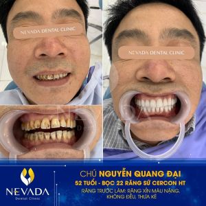 Hình ảnh bọc răng sứ của KH Nguyễn Quang Đại – Ca 60