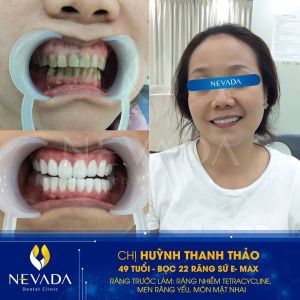 Hình ảnh bọc răng sứ của KH Huỳnh Thanh Thảo – Ca 61