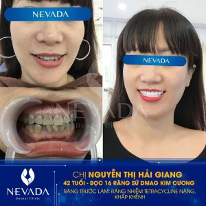 Hình ảnh bọc 16 răng sứ Dmag kim cương của KH Nguyễn Thị Hải Giang – Ca 62