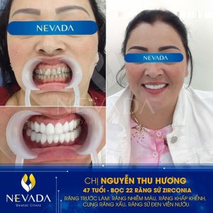 Hình ảnh bọc 22 răng sứ của KH Nguyễn Thu Hương – Ca 63