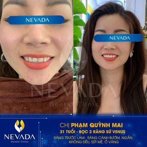 Hình ảnh bọc 2 răng sứ Venus của KH Phạm Quỳnh Mai – Ca 65