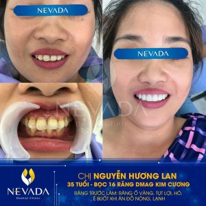 Hình ảnh bọc 16 răng Dmag Kim cương của KH Nguyễn Hương Lan – Ca 64