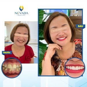 Hình ảnh bọc 16 răng toàn sứ Cercon cao cấp của KH Phương Thanh – Ca 8