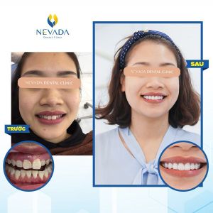 Hình ảnh bọc răng sứ của khách hàng Lê Thu Trang – Ca 9
