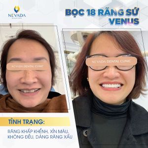 Hình ảnh bọc 18 răng sứ venus của khách hàng Thúy Hằng - Ca 1