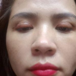 Em vừa làm mí được 8 ngày mà ở chỗ vết cắt có nếp là sao ạ