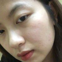 Làm gì với những nốt rỗ trên mặt?