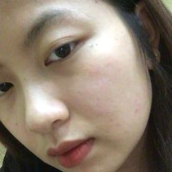 Làm gì với những nốt rỗ trên mặt?