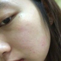 Làm gì với những nốt rỗ trên mặt?