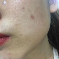 Trị sẹo lõm do bị thủy đậu bằng cách nào?