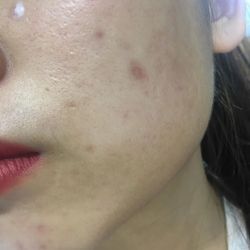 Trị sẹo lõm do bị thủy đậu bằng cách nào?