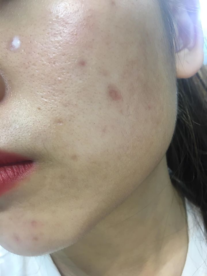 Trị sẹo lõm do bị thủy đậu bằng cách nào? Trị sẹo lõm do bị thủy đậu bằng cách nào?