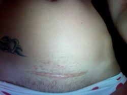 Cơ địa sẹo lồi có làm tăng nguy cơ co thắt bao xơ không?