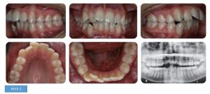 Phân tích case: Chỉnh nha ngụy trang cho bệnh nhân bị hô hàm, răng mọc chen chúc