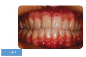Phân tích case: Nhổ răng, tăng cường neo chặn cho bệnh nhân sai khớp cắn hạng II, răng mọc ngầm và chen chúc