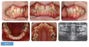 Phân tích case: Nhổ răng, tăng cường neo chặn cho bệnh nhân sai khớp cắn hạng II, răng mọc ngầm và chen chúc