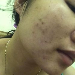 Có nên đi speel da nhiều lần không?