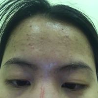 Có nên đi speel da nhiều lần không?