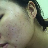 Có nên đi speel da nhiều lần không?