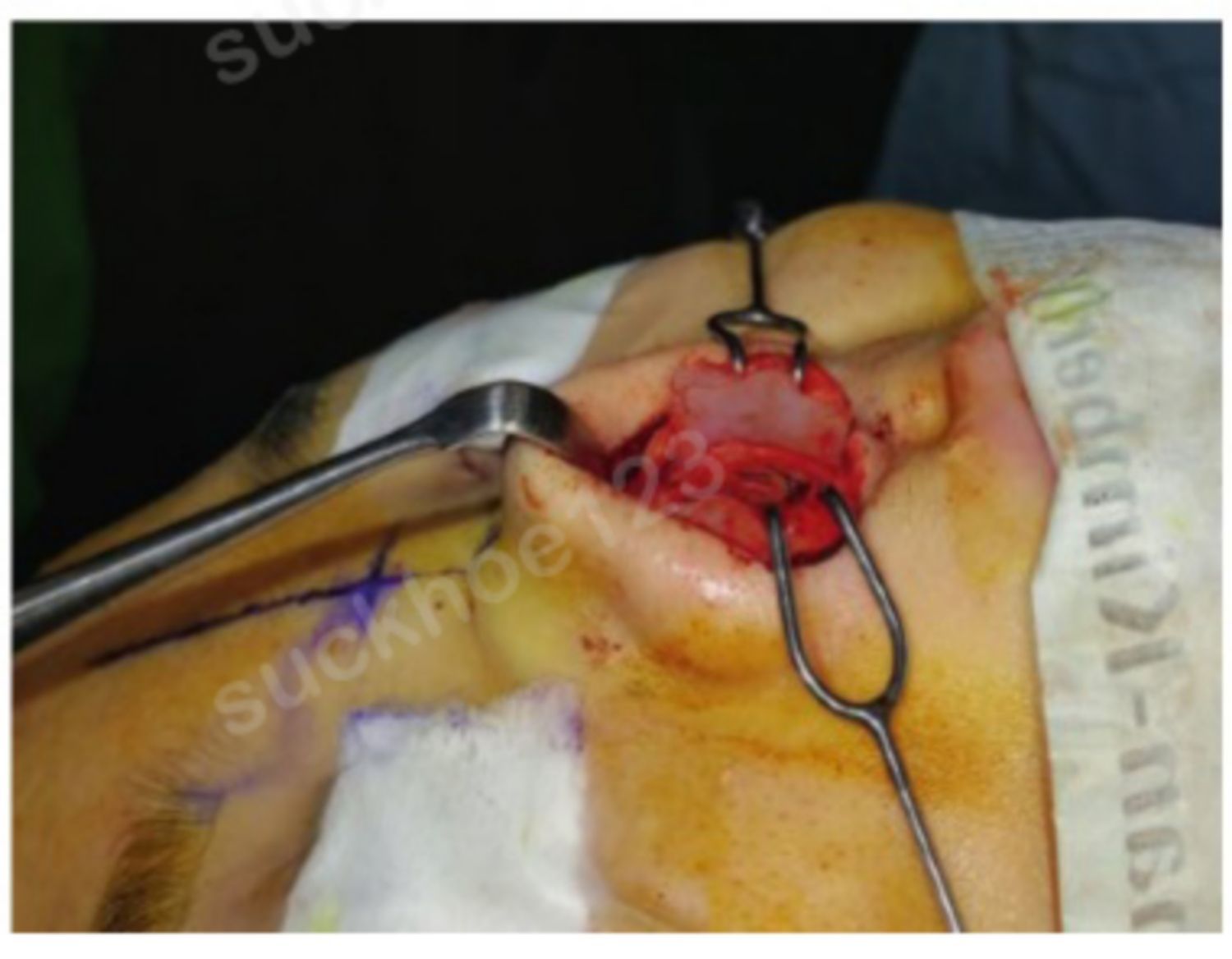 sụn vách ngăn được sử dụng làm miếng ghép mở rộng vách ngăn mũi