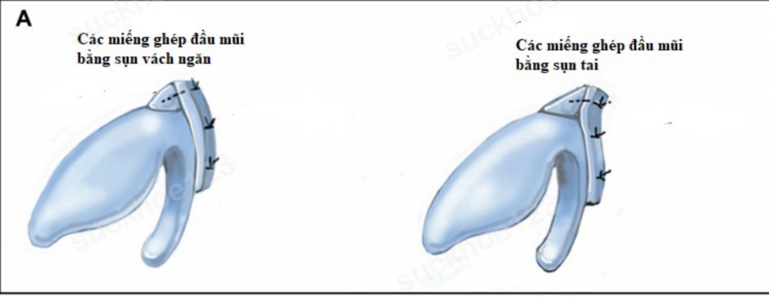 sụn vách ngăn và sụn tai