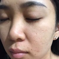 Cách trị thâm mụn?