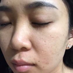 Cách trị thâm mụn?