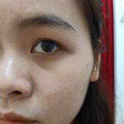 Xin tư vấn cho da dầu mụn, lỗ chân lông to