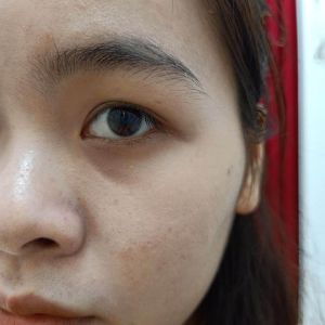 Xin tư vấn cho da dầu mụn, lỗ chân lông to