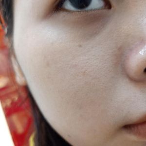 Xin tư vấn cho da dầu mụn, lỗ chân lông to