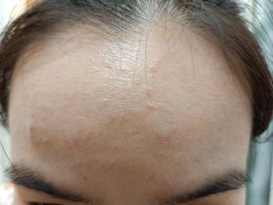 Xin tư vấn cho da dầu mụn, lỗ chân lông to