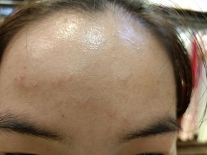 Xin tư vấn cho da dầu mụn, lỗ chân lông to