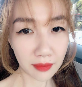 Sửa mí sau 1 năm cắt mí: kết quả bị nhiều nếp mí, lộ đường mí