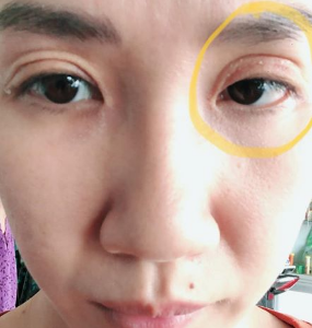 Sửa mí sau 1 năm cắt mí: kết quả bị nhiều nếp mí, lộ đường mí