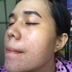 Ăn sầu riêng và thịt bò bị lên mụn là sao?