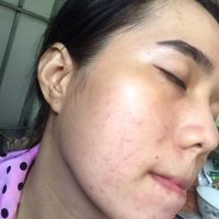 Ăn sầu riêng và thịt bò bị lên mụn là sao? Ăn sầu riêng và thịt bò bị lên mụn là sao?