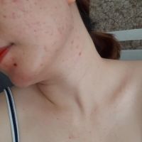 Khắc phục tình trạng mặt nổi mụn ngứa, ngực nổi mụn li ti