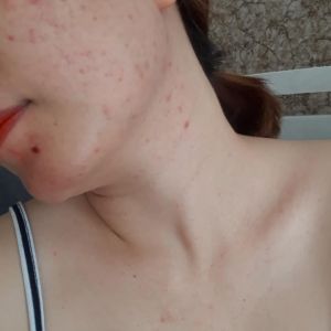 Khắc phục tình trạng mặt nổi mụn ngứa, ngực nổi mụn li ti