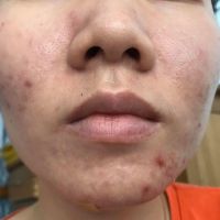Dùng tretinon có đi lăn kim được không? Dùng tretinon có đi lăn kim được không?