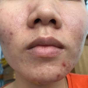 Dùng tretinon có đi lăn kim được không?