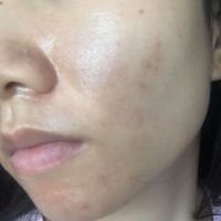 Dùng tretinon có đi lăn kim được không? Dùng tretinon có đi lăn kim được không?