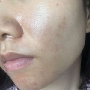 Dùng tretinon có đi lăn kim được không?